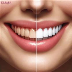 راهنمای کامل سفید کردن دندان | روش های سفید کردن دندان‌ ها